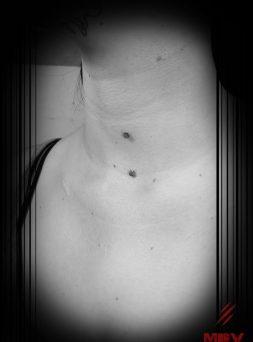 double dermal anchor neck